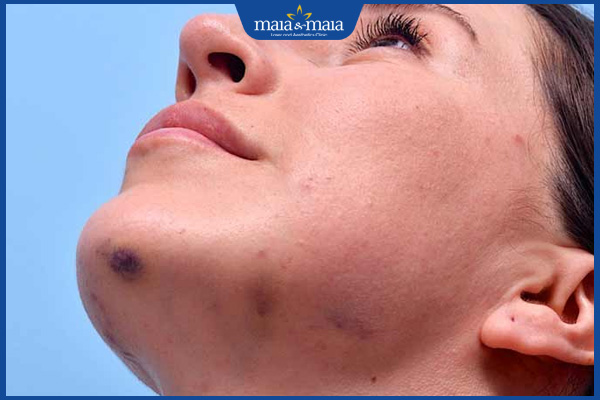 Tiêm filler 5 bầm tím sau tiêm filler