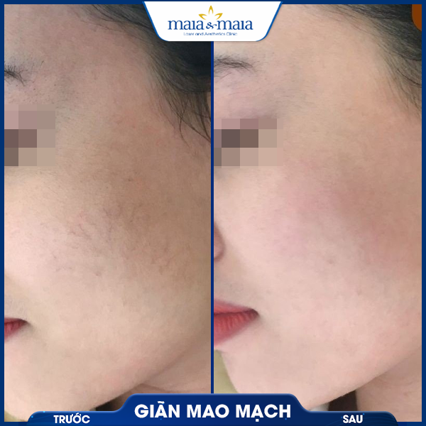Giãn mao mạch 6 khách chữa giãn mao mạch thành công