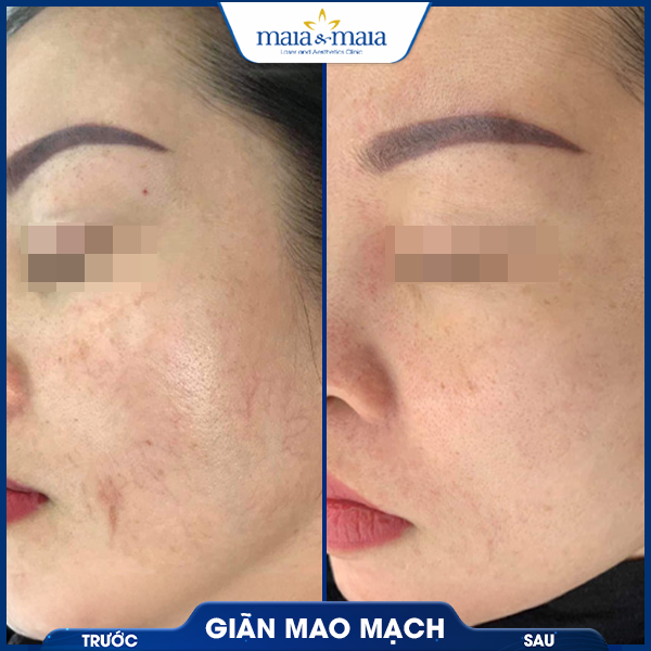 Giãn mao mạch 5 khách chữa giãn mao mạch