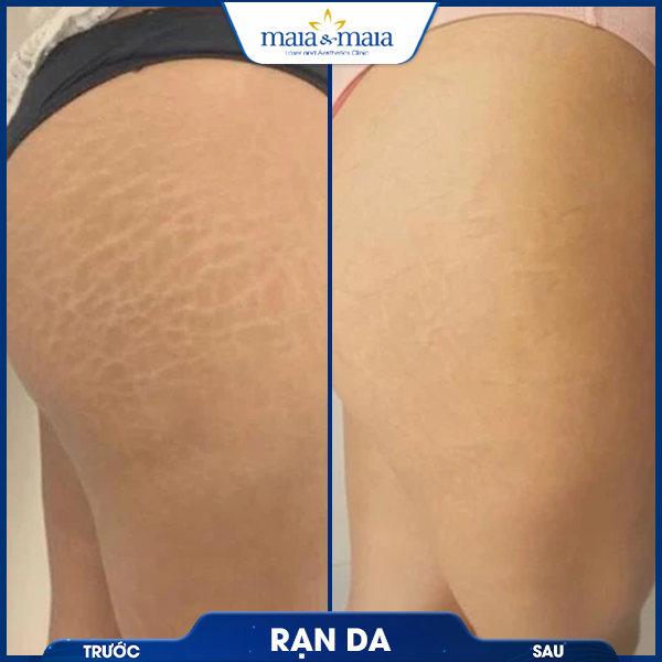 Rạn da 7 khách chữa rạn da thành công