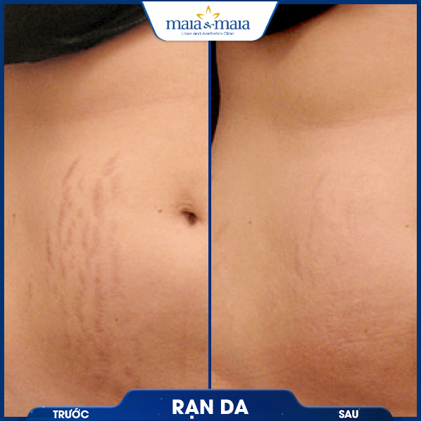 Rạn da 6 khách chữa rạn da
