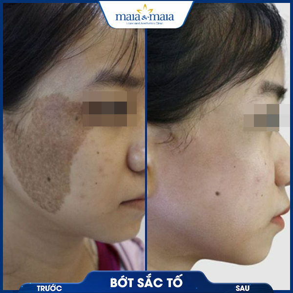 Bớt sắc tố 6 khách điều trị bớt sắc tố thành công