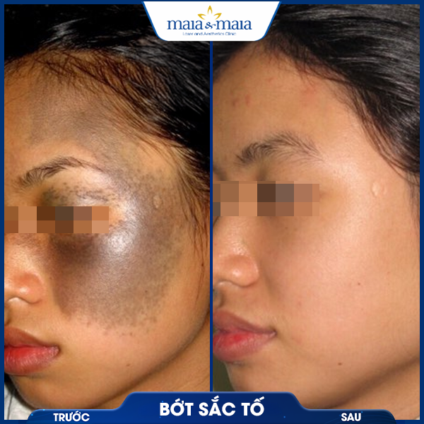 Bớt sắc tố 5 khách điều trị bớt sắc tố