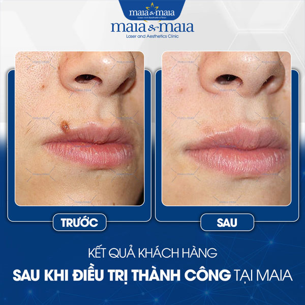Tẩy nốt ruồi 5 khách điều trị nốt ruồi