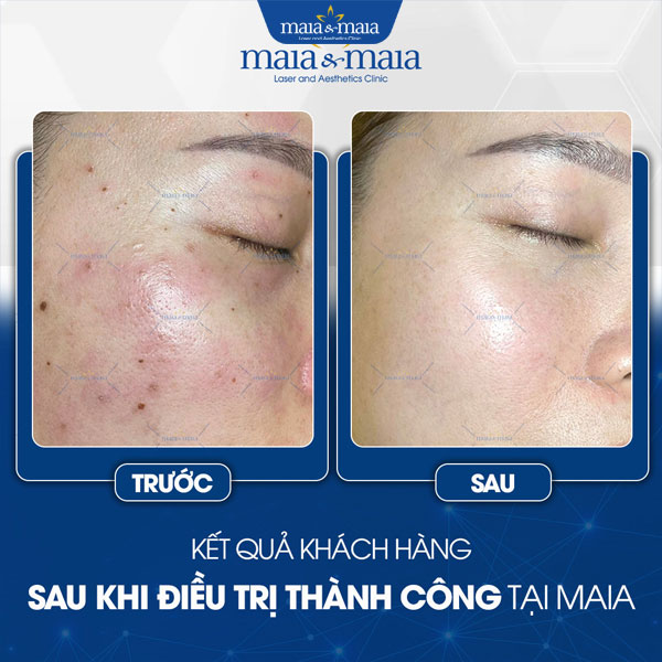 Tẩy nốt ruồi 4 khách điều trị nốt ruồi