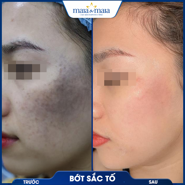 Bớt sắc tố 7 khách hàng điều trị bớt sắc tố