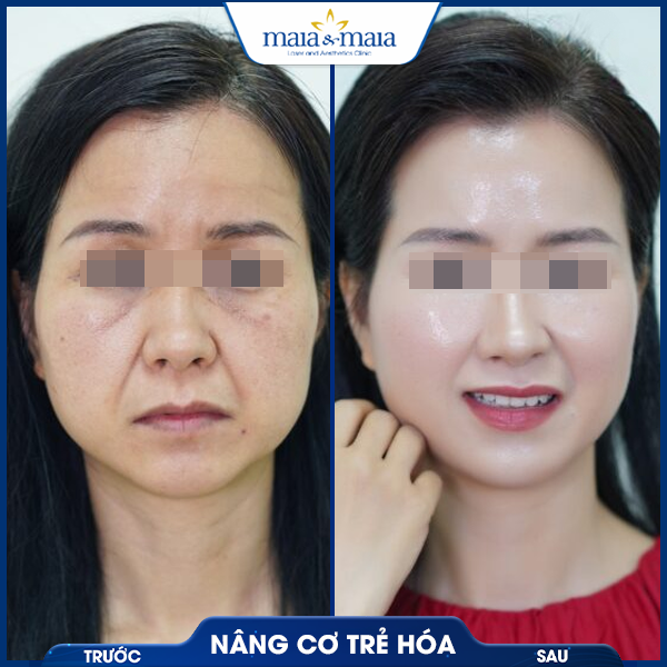 Nâng cơ mặt 6 khách hàng nâng cơ mặt