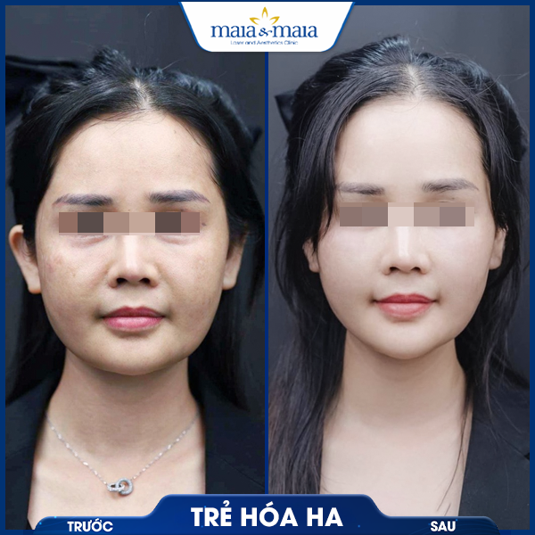 Tiêm trẻ hoá 6 khách hàng thực hiện tiêm trẻ hóa