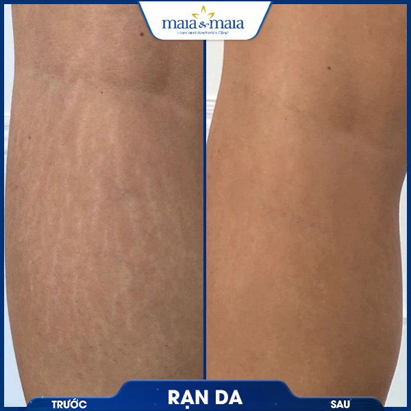 Rạn da 8 khách hàng trị rạn da