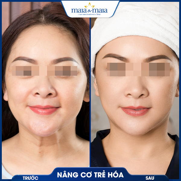Nâng cơ mặt 8 khách nâng cơ mặt thành công