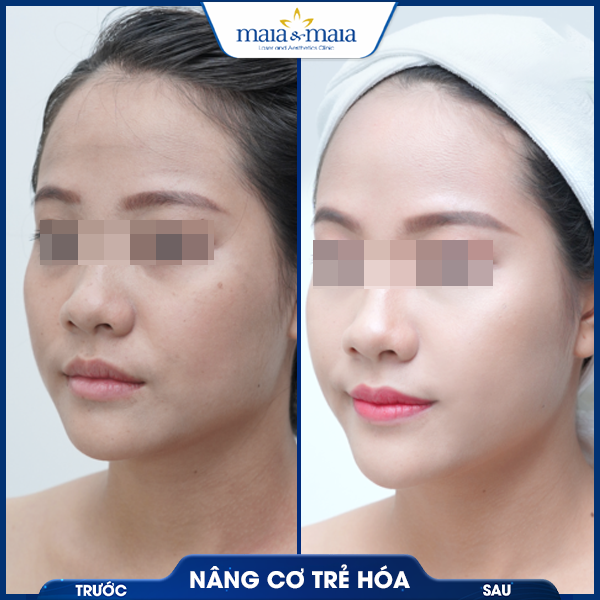 Nâng cơ mặt 7 khách nâng cơ mặt