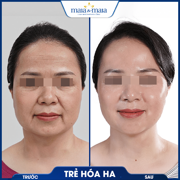Tiêm trẻ hoá 8 khách thực hiện tiêm trẻ hóa thành công