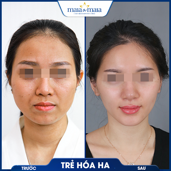Tiêm trẻ hoá 7 khách thực hiện tiêm trẻ hóa
