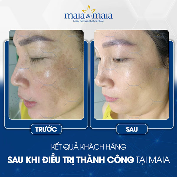 Nám và Tàn nhang 4 khách trị đốm đồi mồi