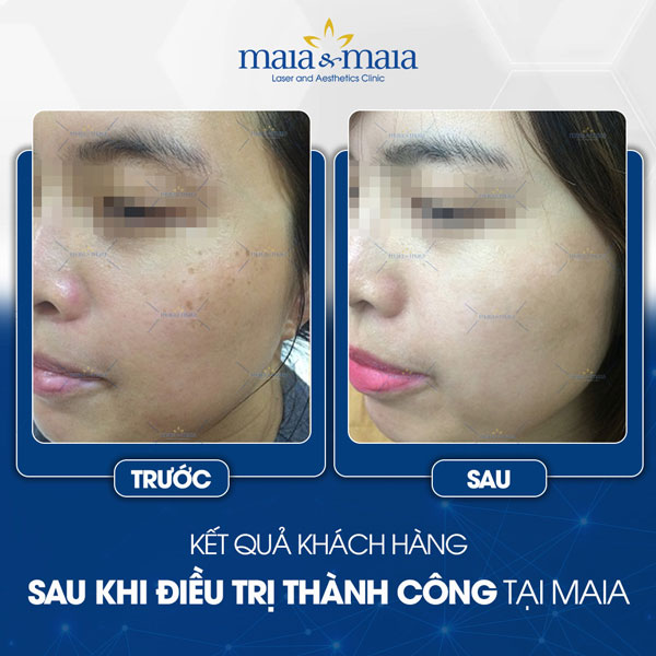 Nám và Tàn nhang 5 khách trị đốm tàn nhang
