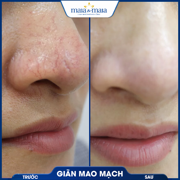 Giãn mao mạch 7 khách trị giãn mao mạch