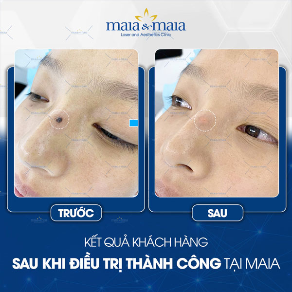 Tẩy nốt ruồi 7 khách trị nốt ruồi thành công
