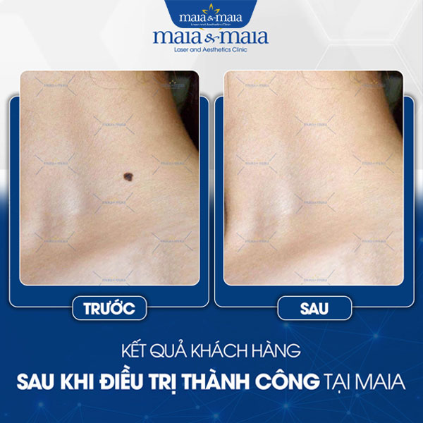 Tẩy nốt ruồi 6 khách trị nốt ruồi