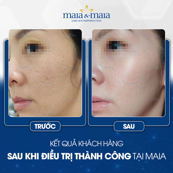 Nám và Tàn nhang 7 khách trị tàn nhang tại maia