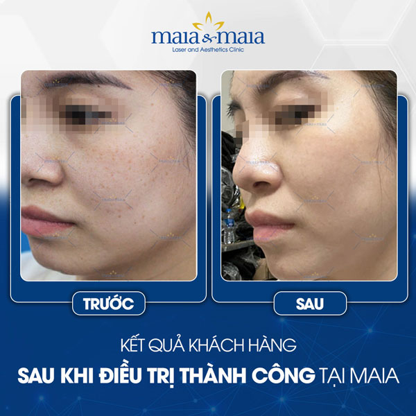 Nám và Tàn nhang 6 khách trị tàn nhang