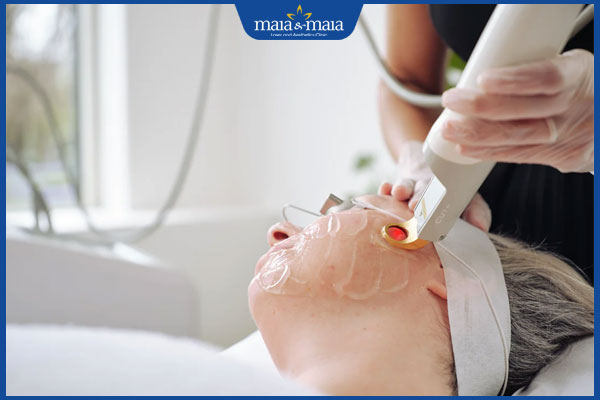 Giãn mao mạch 2 laser trị giãn mao mạch