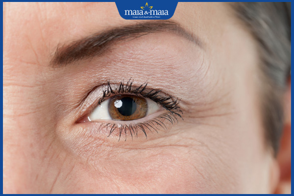 Tiêm filler 3 nếp nhăn ở mắt