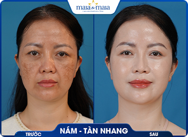 Trang chủ 56 trc sau ld2