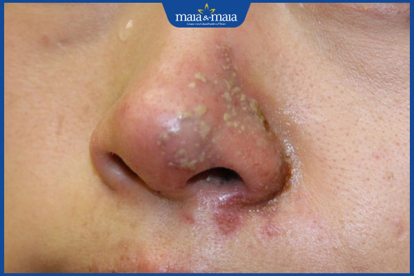 Tiêm filler bị áp xe do đâu? Biện pháp xử lý và phòng ngừa 2 áp xe sau tiêm filler