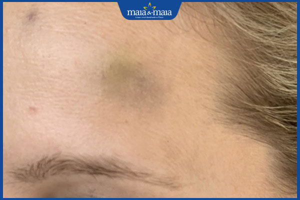 Tiêm filler bị bầm tím: Cách khắc phục và phòng ngừa 2 bam tim sau tiem filler