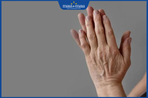 Tiêm filler bàn tay: Giải pháp trẻ hóa tay an toàn, hiệu quả  3 bàn tay bị lão hóa