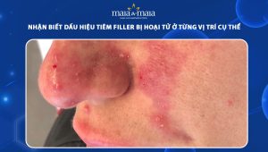 Nhận biết dấu hiệu tiêm filler bị hoại tử ở từng vị trí cụ thể 48 dấu hiệu tiêm filler bị hoại tử