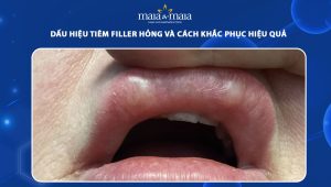 Dấu hiệu tiêm filler hỏng và cách khắc phục hiệu quả 28 dấu hiệu tiêm filler hỏng