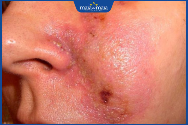 Cảnh báo tiêm filler vào mạch máu: Dấu hiệu nhận biết và cách xử lý 3 hoại tử mô sau tiêm filler