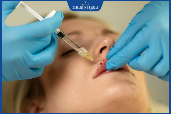 Nhận biết dấu hiệu tiêm filler bị hoại tử ở từng vị trí cụ thể 3 kỹ thuật tiêm filler sai cách