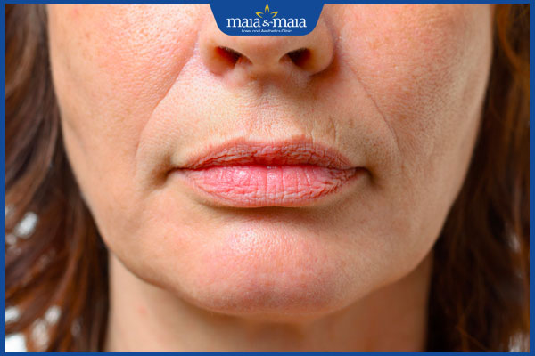 Nếp nhăn tĩnh là gì? Phương pháp làm mờ nếp nhăn hiệu quả 2 nếp nhăn miệng