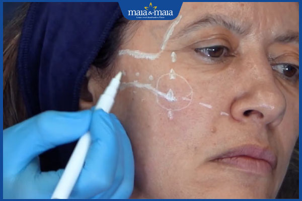 Tiêm filler và botox khác gì nhau? Địa chỉ tiêm uy tín  2 người nên tiêm filler