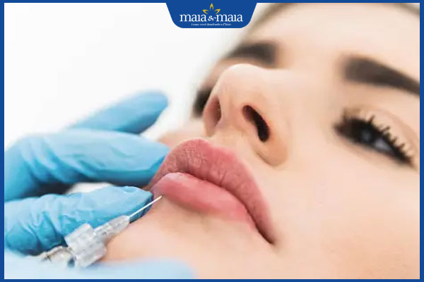 Tiêm filler bị vón cục do đâu? Biện pháp xử lý hiệu quả 3 nguy hiểm sau tiêm filler bị vón cục