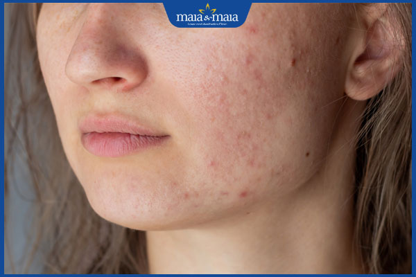 Tiêm filler bị nổi mụn có được nặn không? Cách xử lý phù hợp 2 nhận biết mụn sau tiêm filler