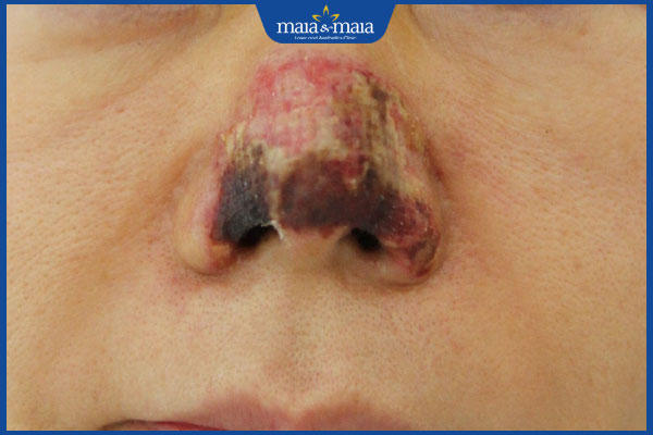 nhiễm trùng sau tiêm filler