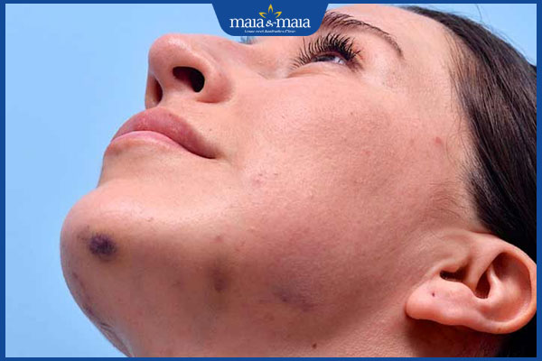 Cảnh báo tiêm filler vào mạch máu: Dấu hiệu nhận biết và cách xử lý 2 rủi ro bị tím sau tiêm filler