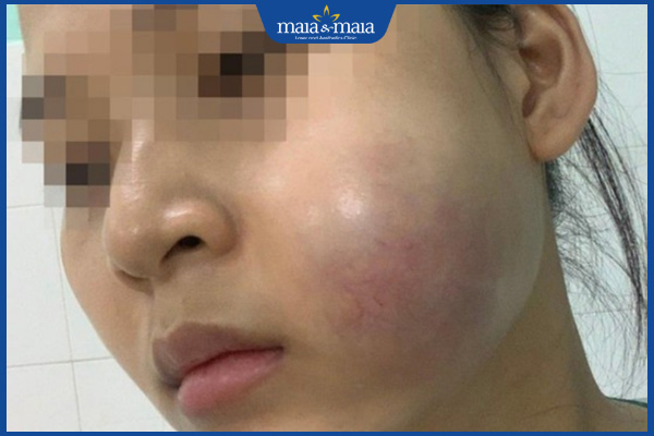 sưng mặt sau tiêm