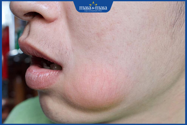 Tiêm filler uống thuốc gì? Lưu ý sử dụng thuốc đúng cách 2 sưng viêm nặng