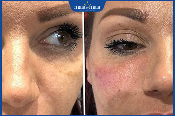 Tiêm filler má là gì? Có đắt không? Địa chỉ thực hiện uy tín 6 tác dụng phụ tiêm filler má