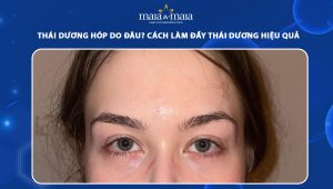 Thái dương hóp do đâu? Cách làm đầy thái dương hiệu quả 70 thái dương hóp