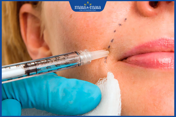 Tiêm tan filler bao lâu tiêm lại được? Cần lưu ý những gì? 2 thời gian tiêm lại filler