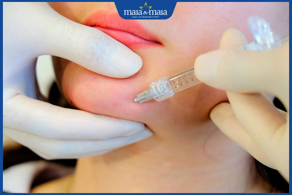 Tiêm filler bao lâu thì ổn định? Bí quyết chăm sóc sau tiêm 2 thực hiện tiêm filler