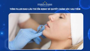 Tiêm filler bao lâu thì ổn định? Bí quyết chăm sóc sau tiêm 83 tiêm filler bao lâu thì ổn định