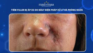 Tiêm filler bị áp xe do đâu? Biện pháp xử lý và phòng ngừa 50 tiêm filler bị áp xe