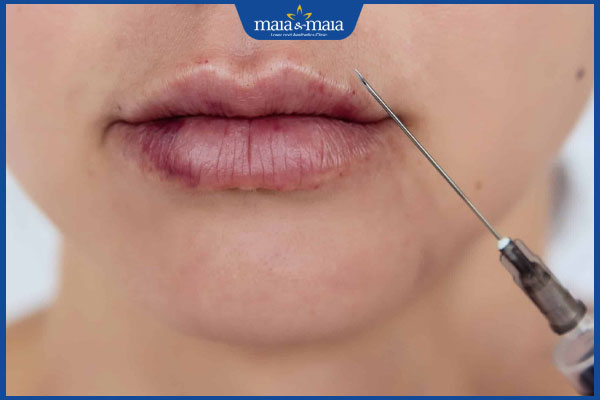 Tiêm filler bị nhức do đâu? Cách phòng ngừa đau nhức do tiêm 2 tiêm filler bị lỗi