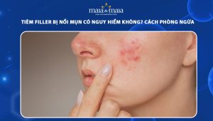 Tiêm filler bị nổi mụn có được nặn không? Cách xử lý phù hợp 48 tiêm filler bị nổi mụn